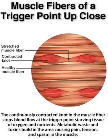 trigger points