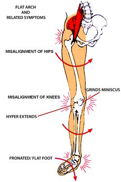 collapsed foot arch