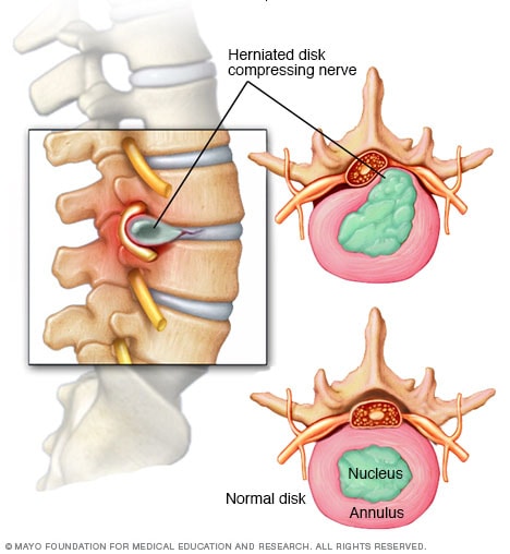 Herniated Disc Symptoms Diagram