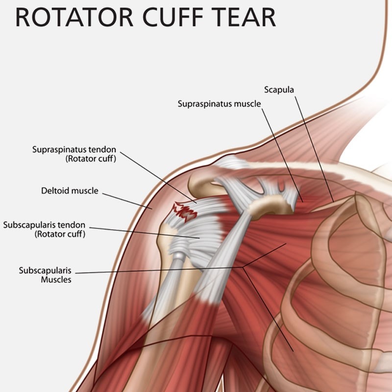 pain relief for torn rotator cuff