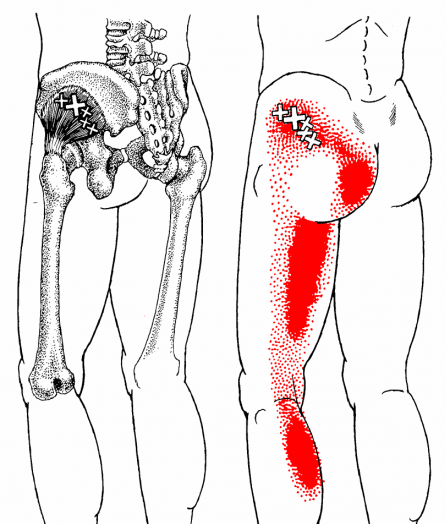 psoas pain referral pattern