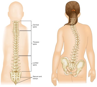 idiopathic scoliosis