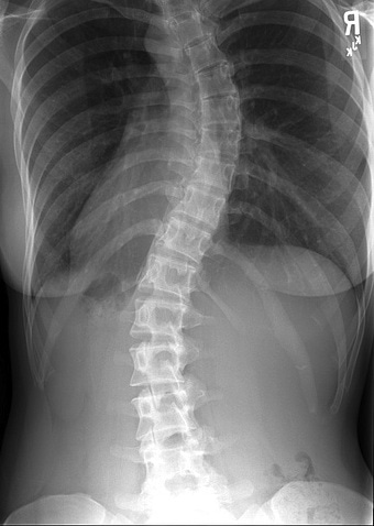 mild scoliosis x ray