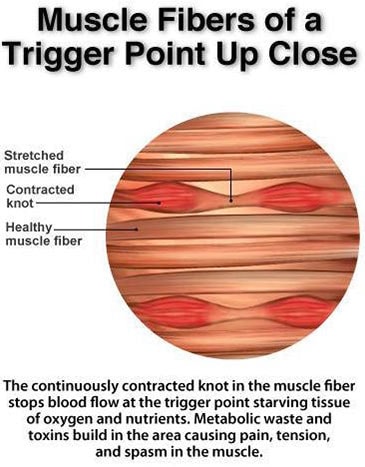 Trigger point deals lower back