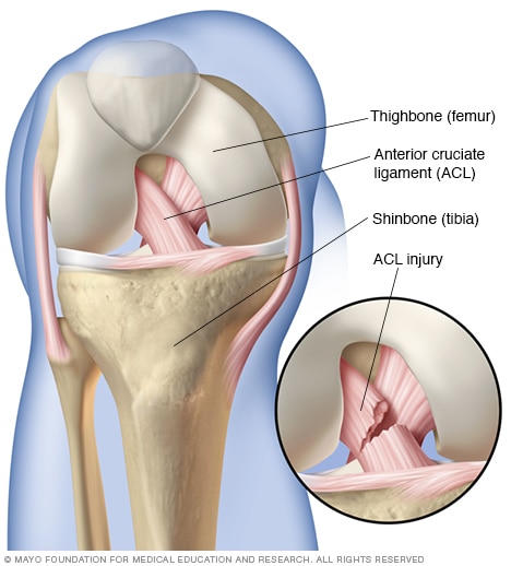 Knee Pain Treatment: Healing a Ligament Tear