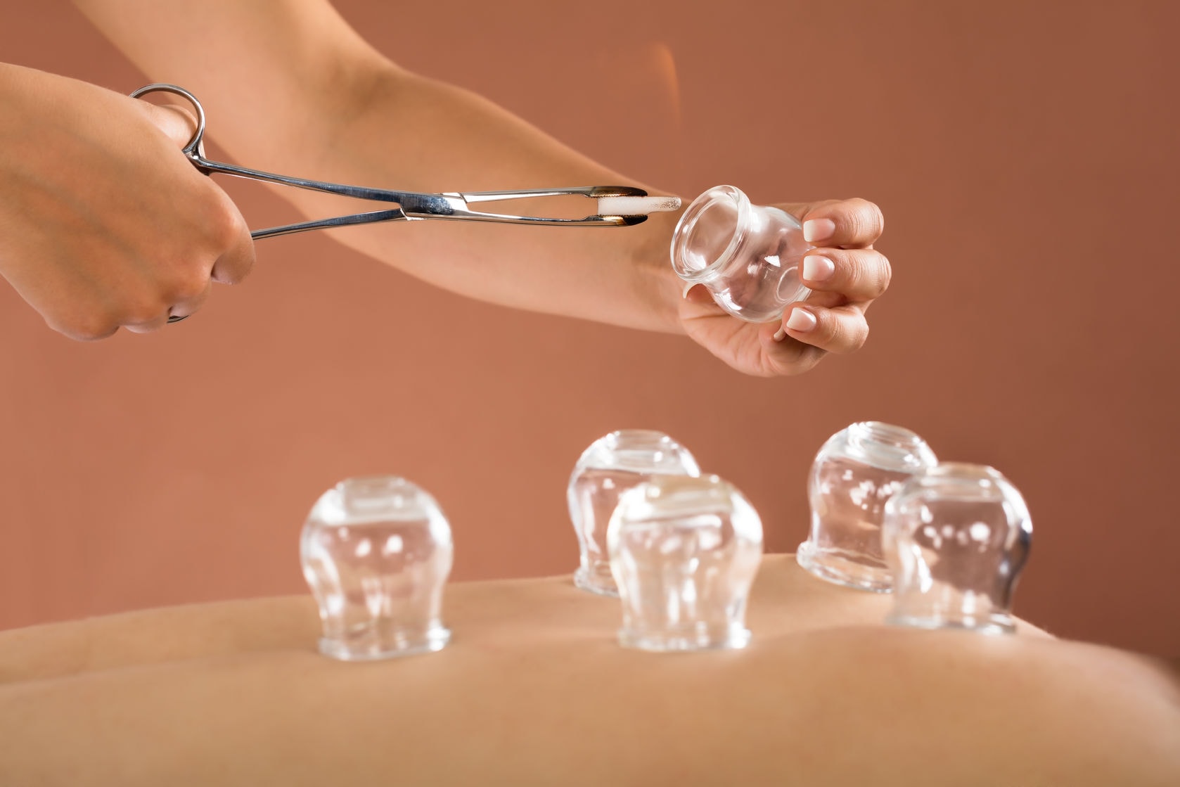 Cupping Before it Was Cool - Cupping Therapy | https://physiologicnyc.com/acupuncture/