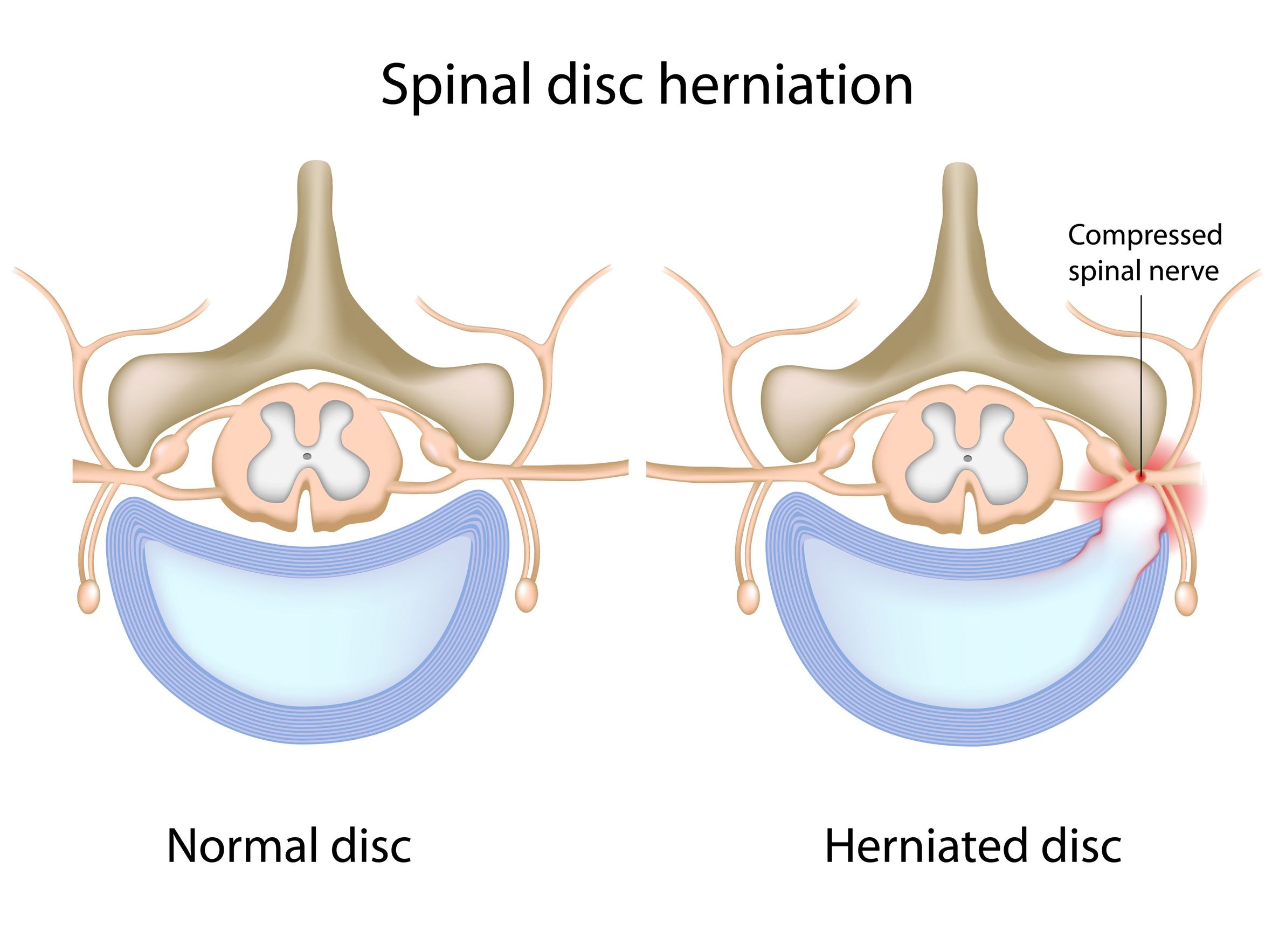 Spinal Disc Herniation Diagram - Normal Spinal Disc and Herniated Spinal Disc Diagram | https://physiologicnyc.com/chiropractic/