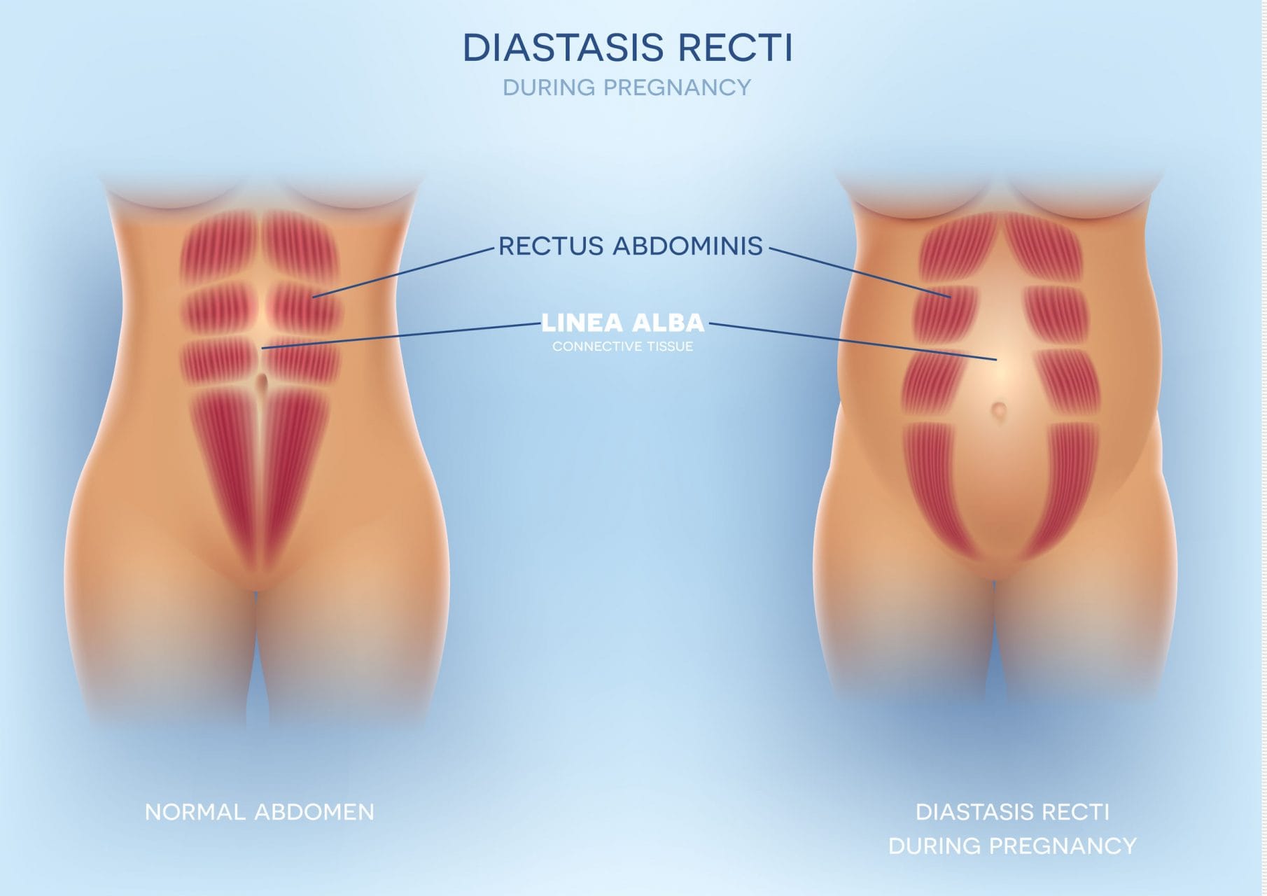 Diastasis Recti - Diastasis Rectus Abdominis or Separation of Abdominals During Pregnancy | https://physiologicnyc.com/physical-therapy/