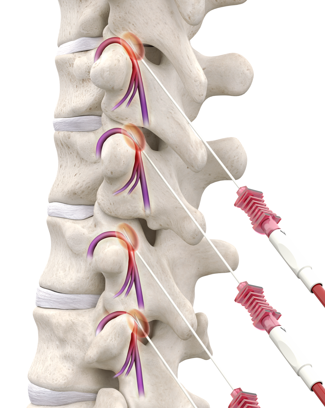 Lumbar Radiofrequency Ablation (RFA) For Pain Relief