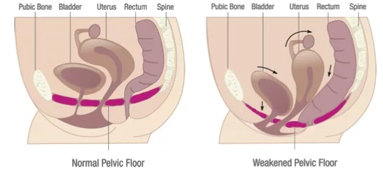 pelvic floor pain after c-section