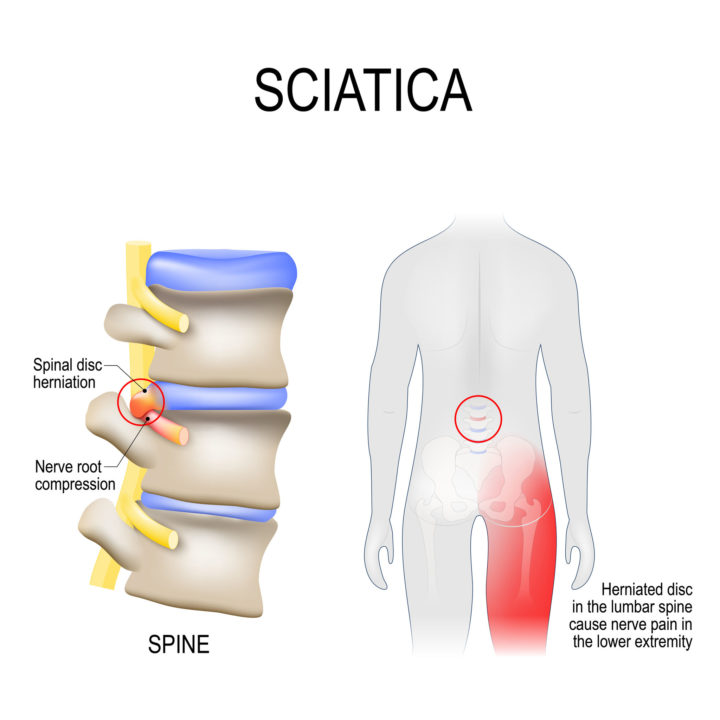 Sciatica nerve pain diagram showing herniated disc pressing on sciatic nerve, cause sciatica pain down leg.