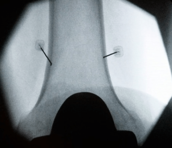 Fluoroscopy for knees in Brooklyn, NY at Physio Logic NYC.