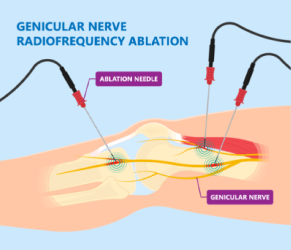 Radiofrequency nerve ablation for knees in Brooklyn, NY at Physio Logic NYC.