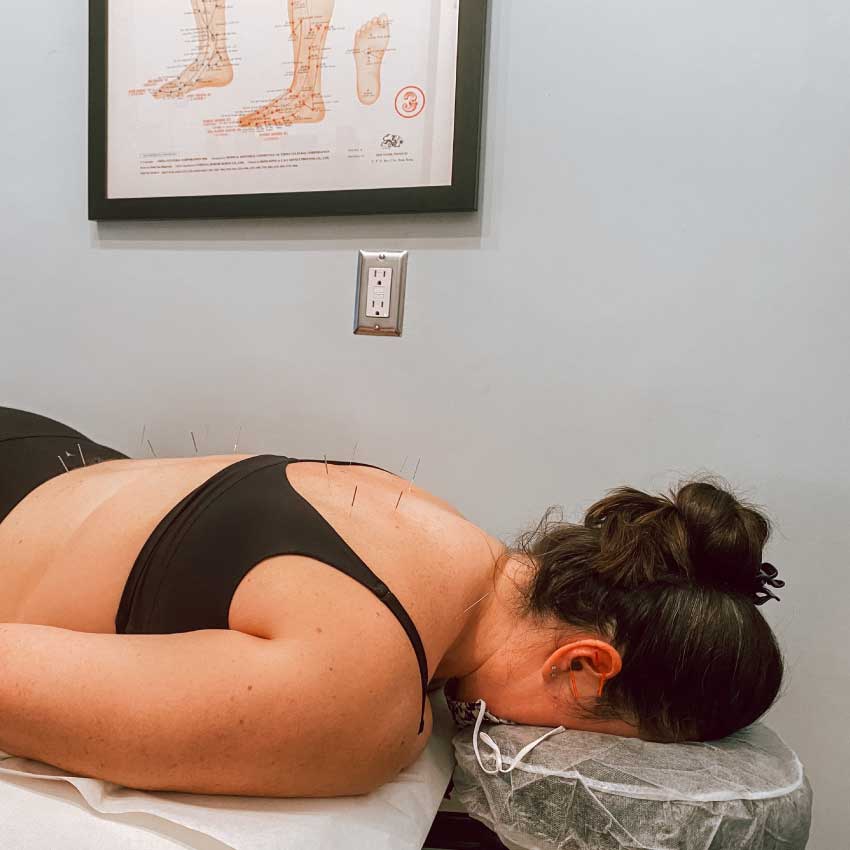 Woman getting acupuncture for weight loss at Physio Logic NYC in Brooklyn, NY.