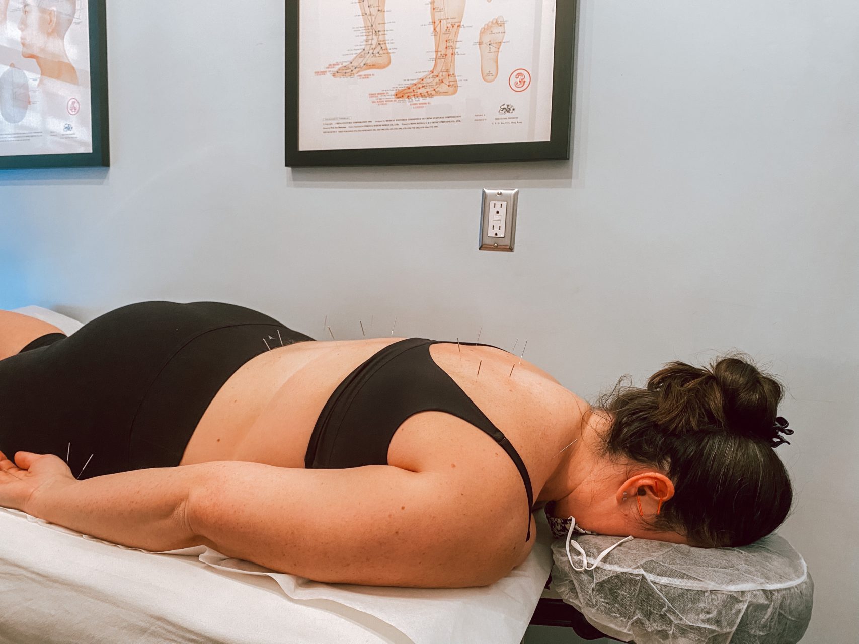 Woman receiving acupuncture at Physio Logic NYC in Brooklyn, NY to experience acupuncture benefits.